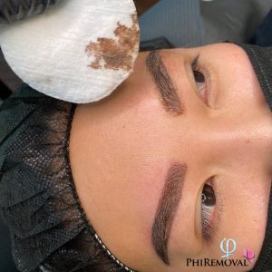 PhiRemoval Eyebrow Tattoo Removal