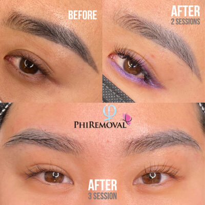 Irene EyeBrow Removal Kayana Beauty Three Sessions