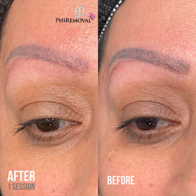 Wendy Eyebrow Removal Kayana Beauty One Session